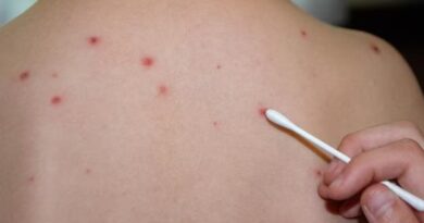 ЖАМБЫЛ ОБЛЫСЫНДА ҚЫЗЫЛША СЫРҚАТТАНУ ДЕҢГЕЙІ 1,4 ЕСЕГЕ АЗАЙДЫ