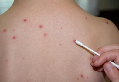 ЖАМБЫЛ ОБЛЫСЫНДА ҚЫЗЫЛША СЫРҚАТТАНУ ДЕҢГЕЙІ 1,4 ЕСЕГЕ АЗАЙДЫ